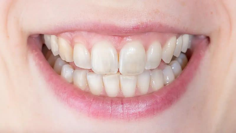 20 tuổi niềng răng bao nhiêu tiền? Niềng mất bao lâu?