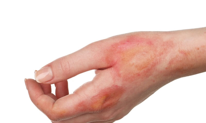 Các bước sơ cứu bỏng kiềm mà ai cũng nên biết 2