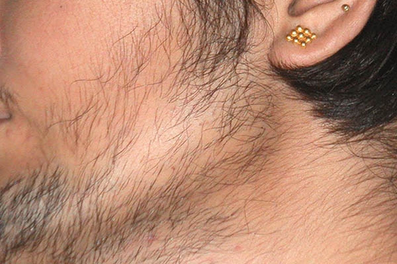 Ung thư phổi di căn tuyến thượng thận và phương pháp chữa bệnh 3