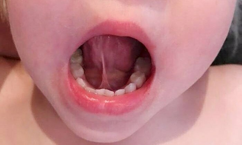 Điều trị tật dính thắng lưỡi độ 4 như thế nào? 1