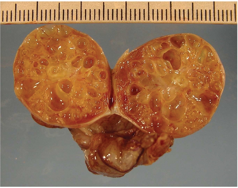 Những điều cần biết về khối u thể granulosa 1