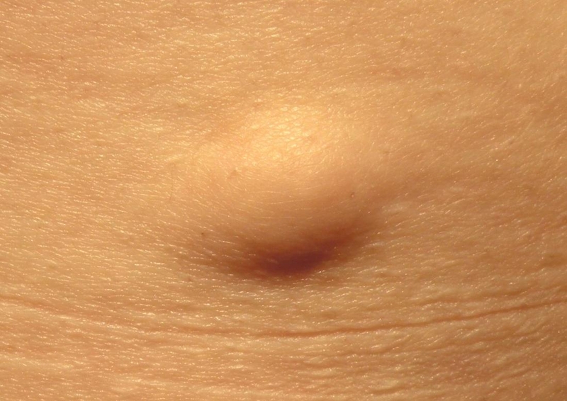 Lipoma (u mỡ) là gì? Có nguy hiểm không? 1