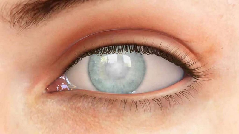 Mắc bệnh loạn thị có nên đeo kính không? 1