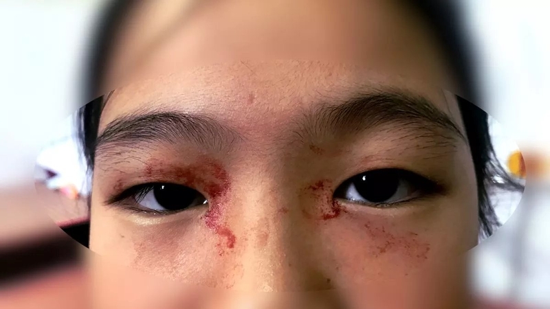 Mồ hôi máu là gì? Nguyên nhân và triệu chứng 1