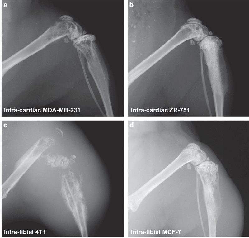 Ung thư vú di căn xương: Tiên lượng và xét nghiệm1