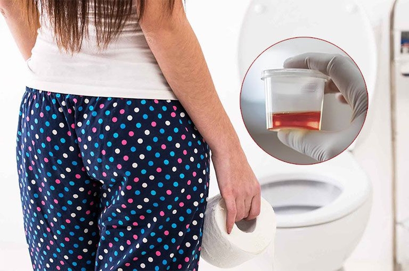 Nguyên nhân gây ra tiểu máu là gì? 1