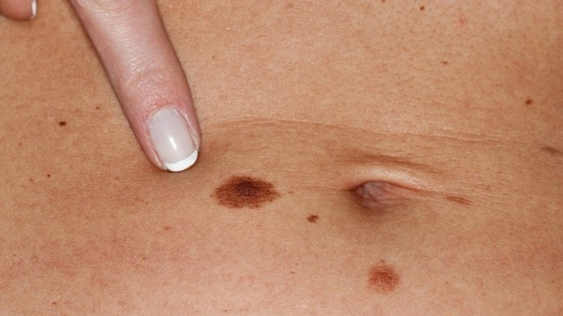 cac-giai-doan-ung-thu-da-cach-luu-y-va-danh-gia-ung-thu-da 2