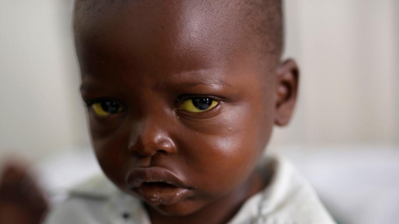 Yellow fever là gì? Triệu chứng và nguyên nhân gây bệnh 1