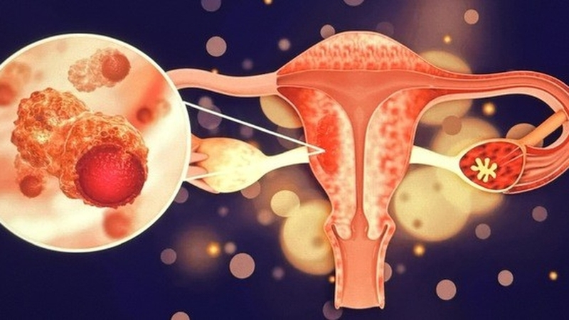 Lạc nội mạc buồng trứng là gì? Nguyên nhân, triệu chứng và cách điều trị?+2