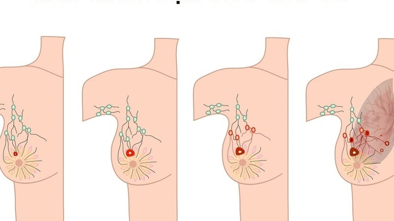 Những loại thuốc điều trị ung thư vú thường được sử dụng 2