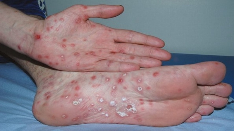 Xét nghiệm RPR là gì? Tại sao cần làm xét nghiệm RPR?+2