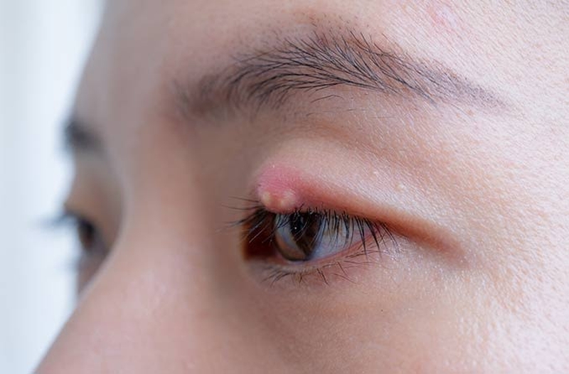 Lẹo mắt bên ngoài và cách điều trị lẹo mắt hiệu quả tại nhà 1