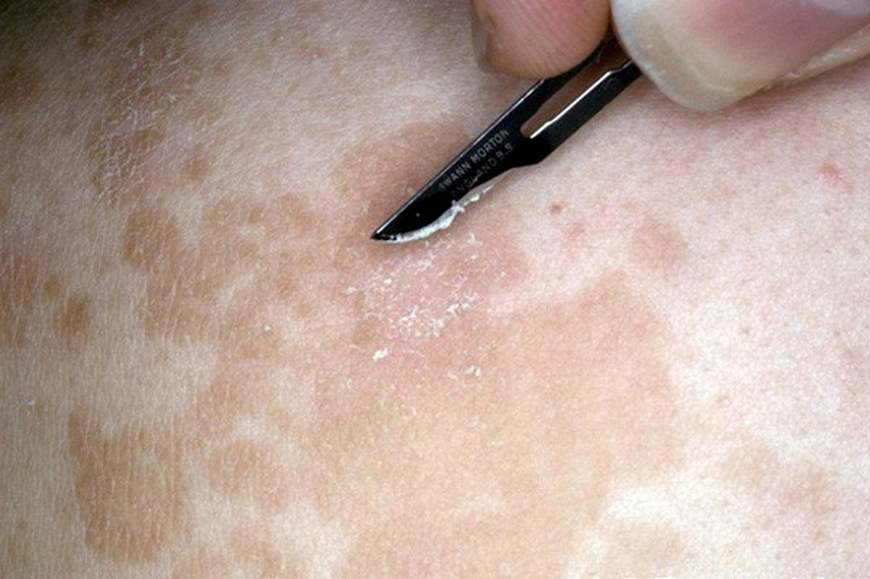 Cách trị lang beng đen hiệu quả và nhanh chóng