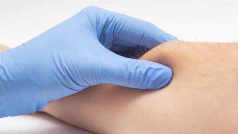 Lipoma (u mỡ) là gì? Có nguy hiểm không? 2