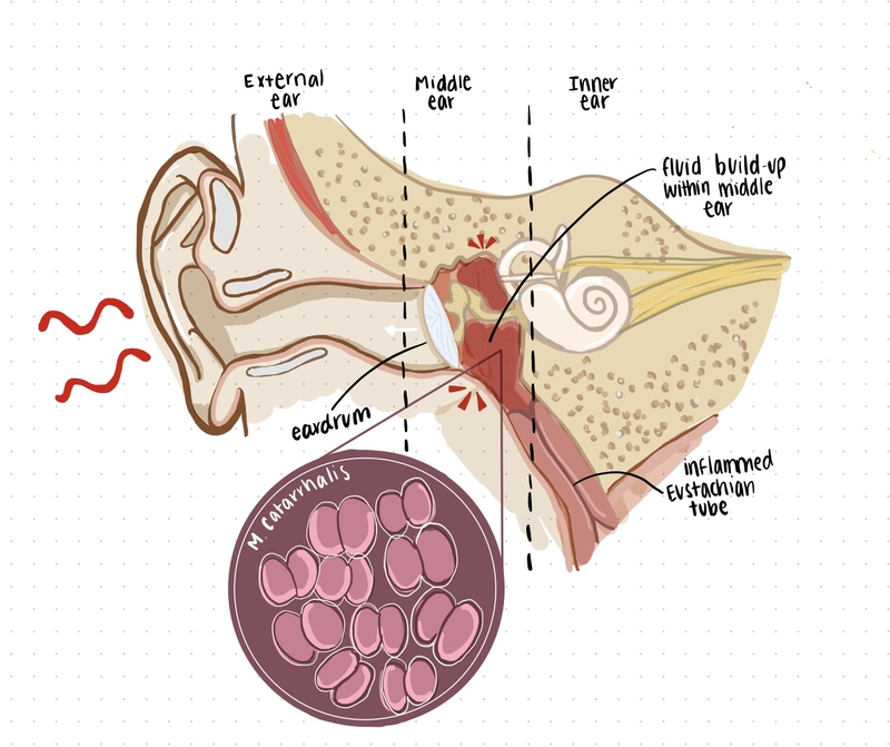 Moraxella Catarrhalis là gì? Vi khuẩn gây bệnh gì? 2