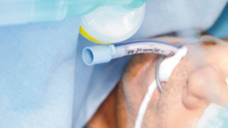 Những điều cần biết về sẹo hẹp khí quản 2