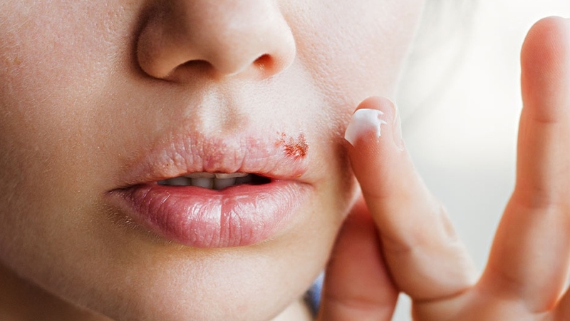 Bóc vảy mụn: Nên hay không nên? 4