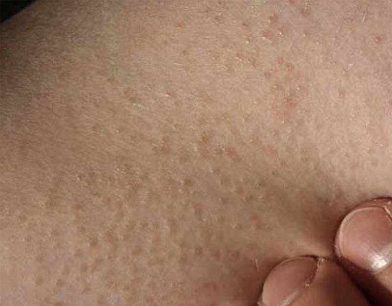 3 bài thuốc Đông y chữa dày sừng nang lông đơn giản tại nhà 1