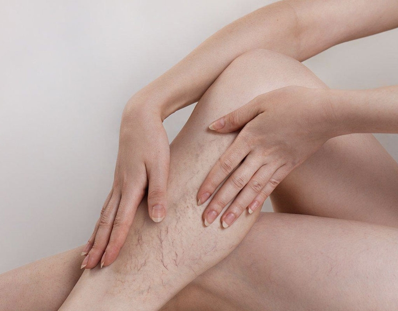 3 bài thuốc Đông y trị suy giãn tĩnh mạch 2