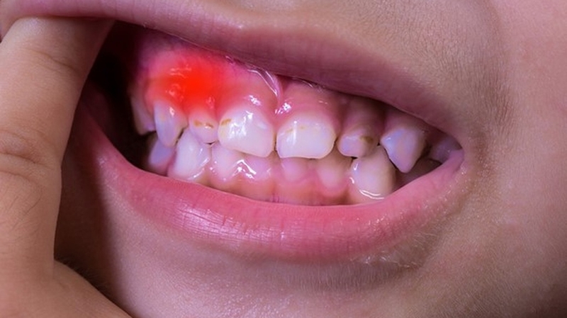 Cách chữa viêm lợi cho trẻ dưới 2 tuổi hiện nay? Các lưu ý gì khi điều trị viêm lợi cho trẻ+3