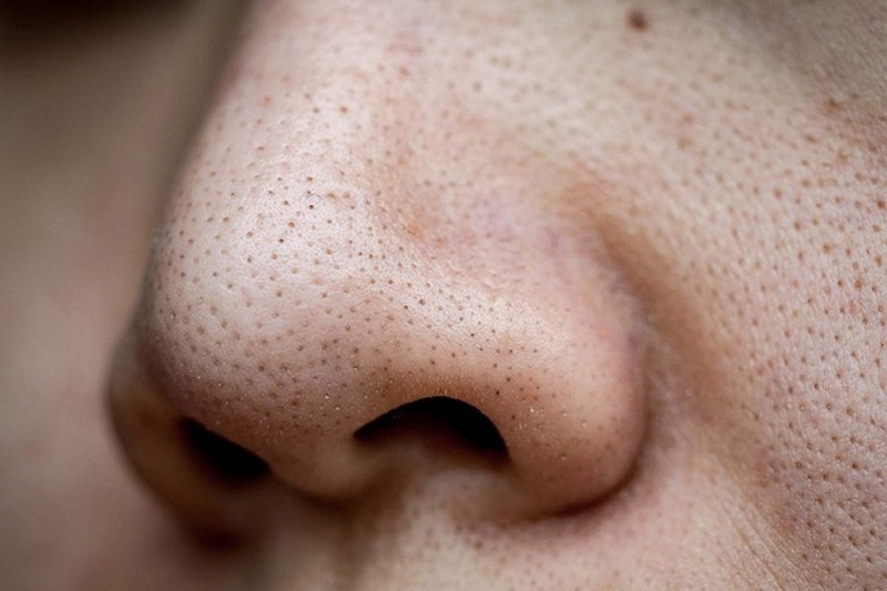 các cách trị mụn đầu đen và lỗ chân lông to