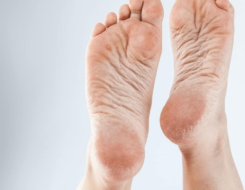 3 cách trị nứt gót chân bằng Vaseline bạn đã biết chưa? 1