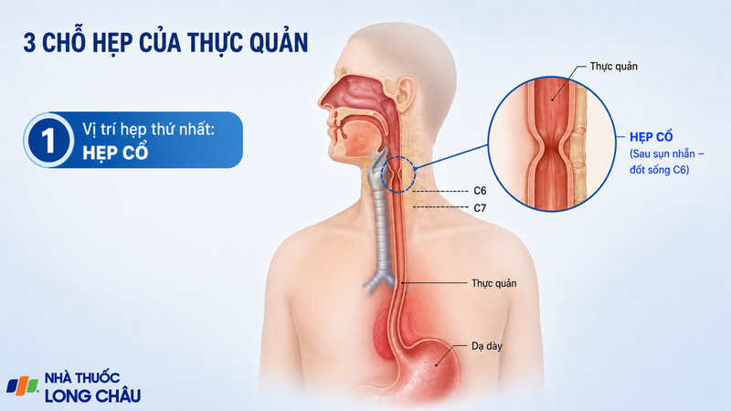 Hẹp cổ nằm ở đầu thực quản, ngang mức C6 và là vị trí hẹp nhất