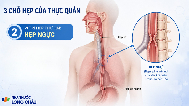 Hẹp ngực liên quan vị trí thực quản bị chèn ép bởi các cấu trúc lồng ngực