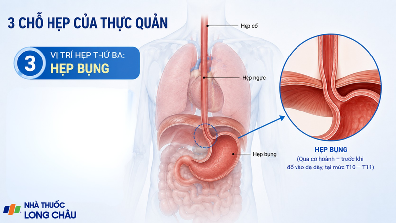 Hẹp bụng nằm tại nơi thực quản đi qua cơ hoành để nối với dạ dày