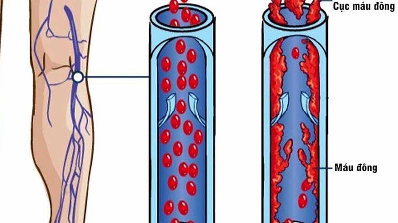 Đặt thuốc Cyclogest bao lâu tan hết? Những lưu ý khi sử dụng thuốc trong quá trình điều trị + 3