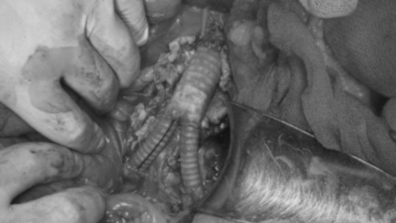 Các bác sĩ thay đoạn mạch tổn thương bằng mảnh ghép nhân tạo chữ Y