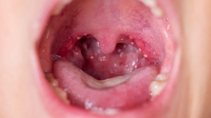 hidrasec-30mg-nen-uong-truoc-hay-sau-an-luu-y-gi-khi-su-dung-thuoc-hidrasec-30mg 3