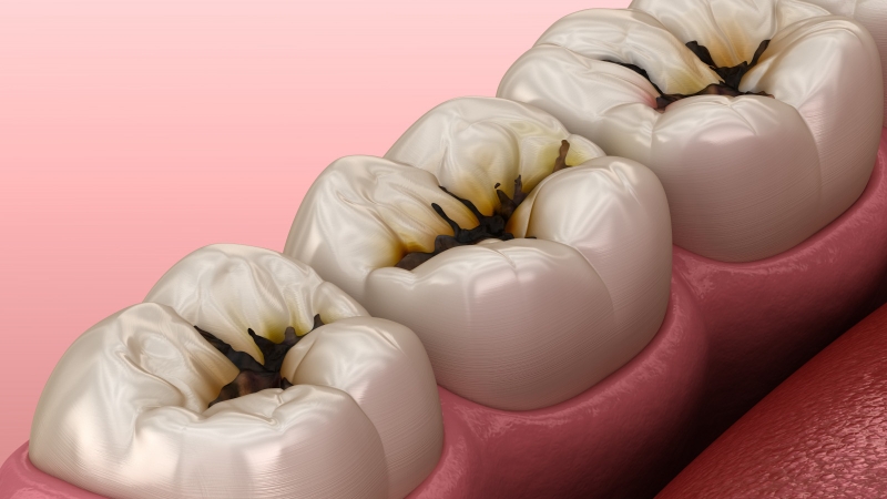3 mức độ sâu răng là gì? Cách điều trị như thế nào? 1