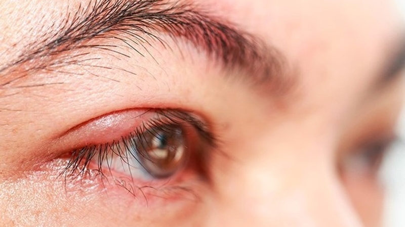 tai-sao-bi-liet-mat-cac-phuong-phap-phuc-hoi-chuc-nang-sau-khi-bi-liet-mat-la-gi 3