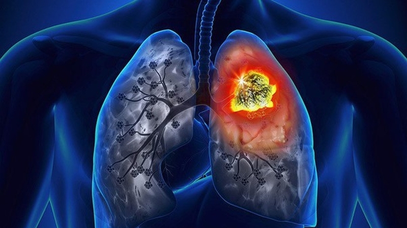 Xét nghiệm CEA - Phương pháp chẩn đoán các bệnh ung thư +3