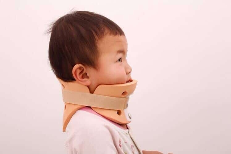 Một số điều cần biết khi trẻ bị vẹo cổ nghiêng đầu ở trẻ 1