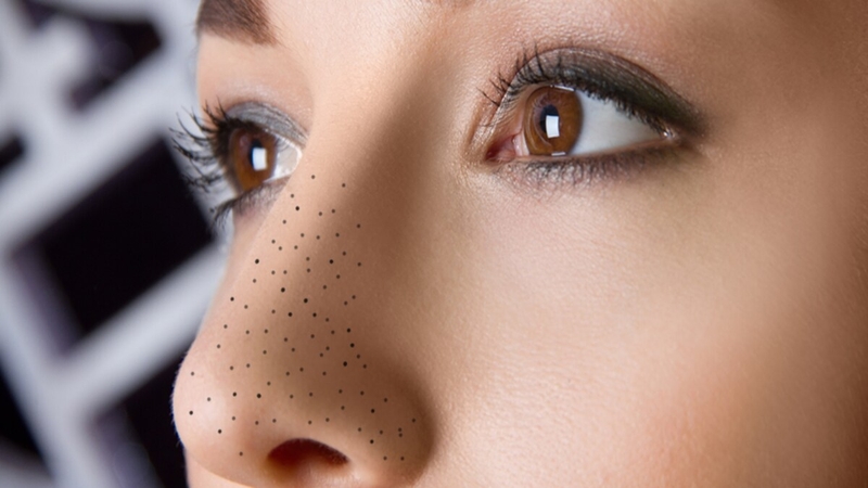 Công nghệ IPL trị mụn như thế nào? 2