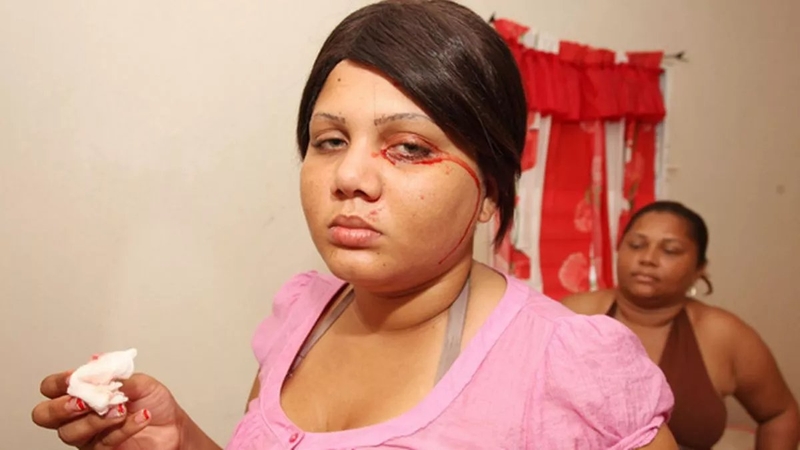 Mồ hôi máu là gì? Nguyên nhân và triệu chứng 3