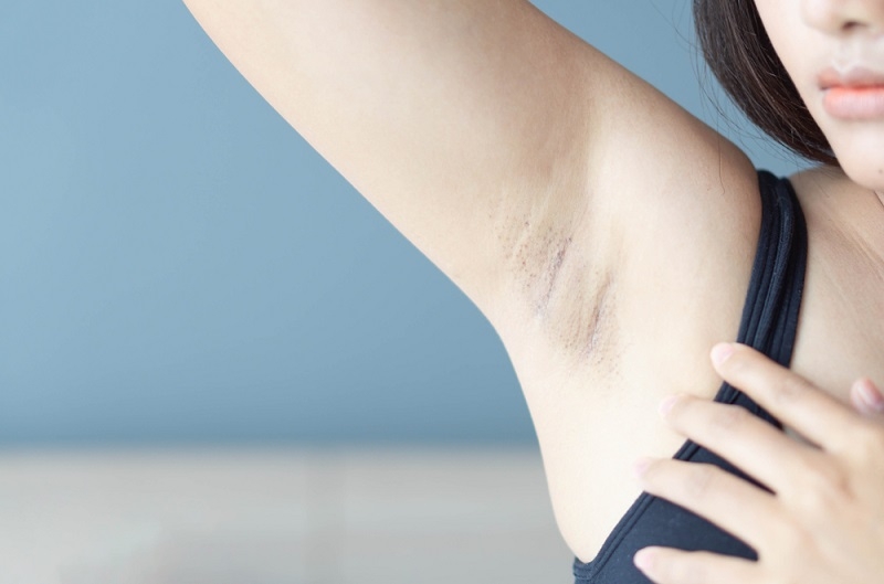 Sau khi triệt lông nách nên kiêng gì cho làn da? 2