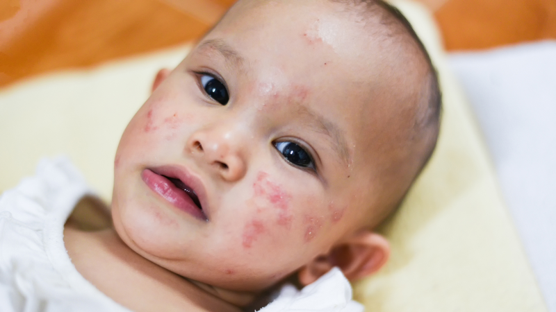 4 bệnh về da thường gặp nhất vào thời điểm chuyển mùa 3