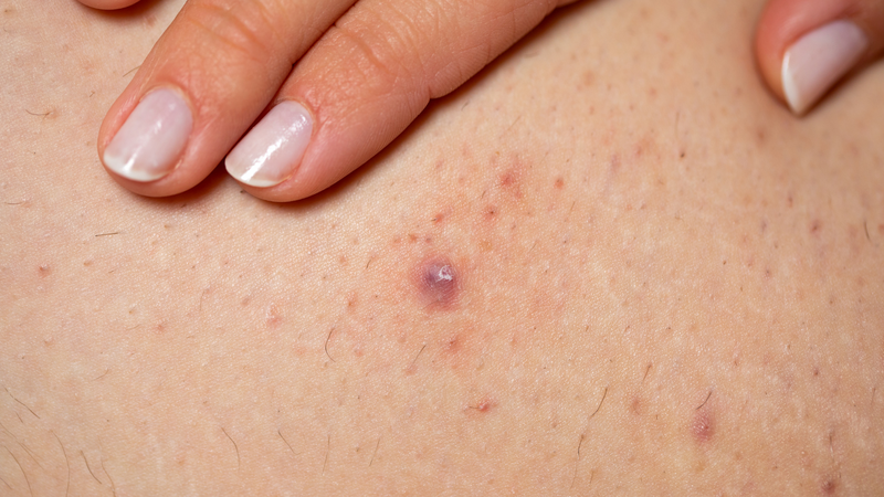 4 bệnh về da thường gặp nhất vào thời điểm chuyển mùa 4