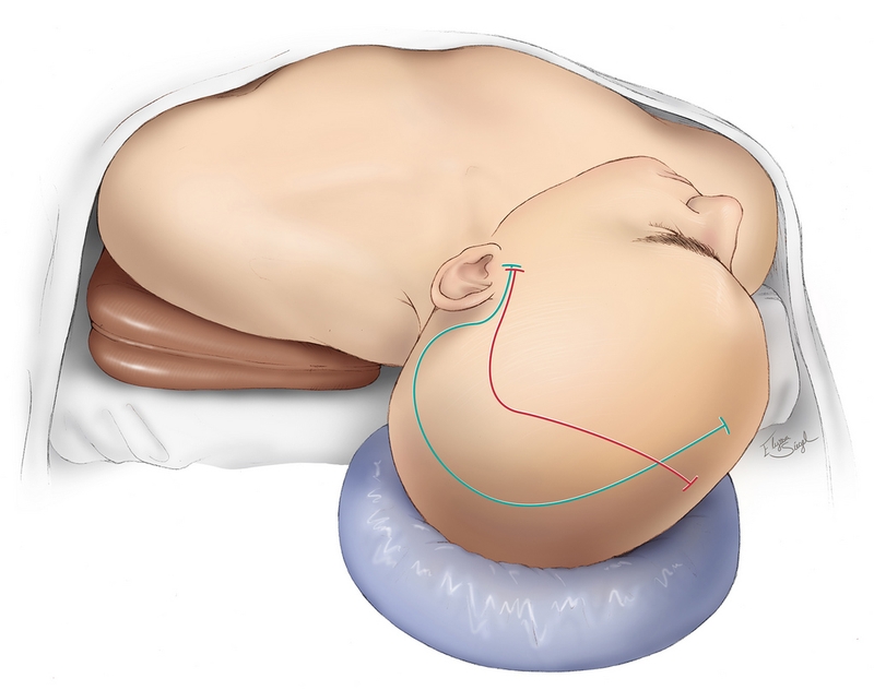 4 biến chứng sau ghép sọ nguy hiểm nhất và dấu hiệu phát hiện sớm 1
