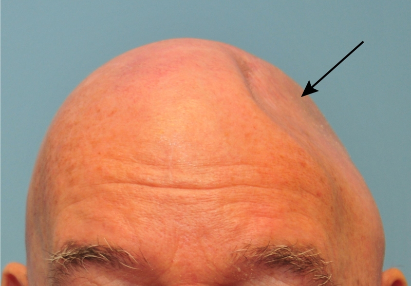 4 biến chứng sau ghép sọ nguy hiểm nhất và dấu hiệu phát hiện sớm 3