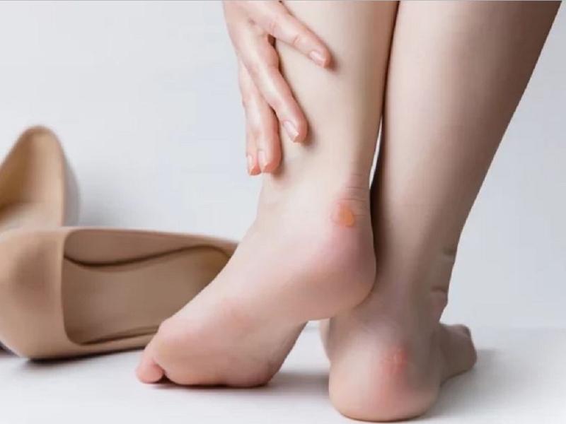 Bật mí các cách trị phồng chân hiệu quả và những lưu ý cần biết khi điều trị 1