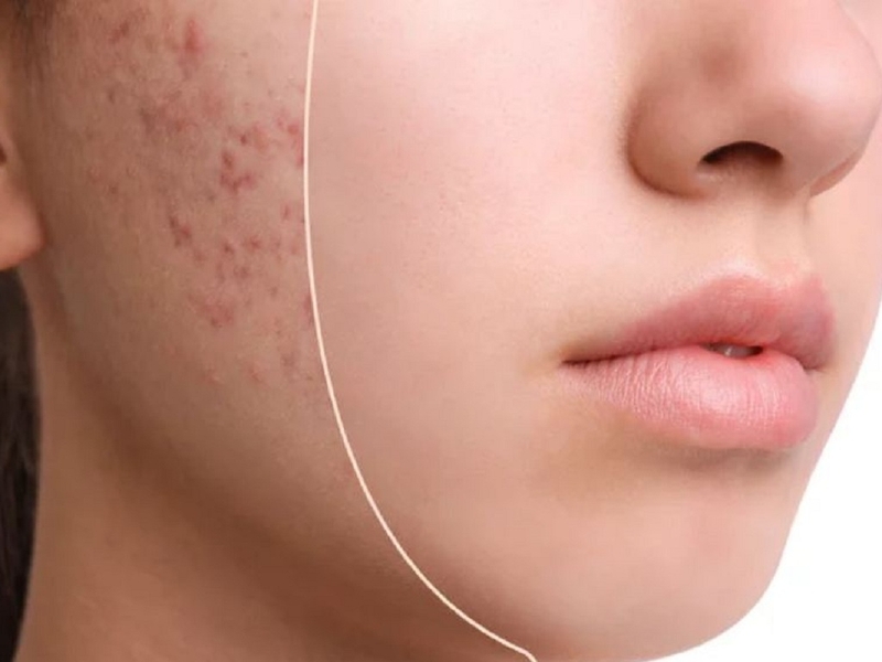 Cách khắc phục mụn trứng cá