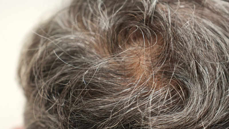 Vị trí tóc bạc ở đỉnh đầu có thể liên quan quá trình lão hóa