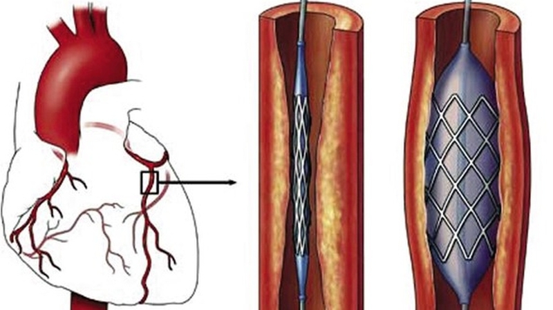 Xét nghiệm CK - MB là gì? Tại sao cần làm xét nghiệm CK - MB?+4