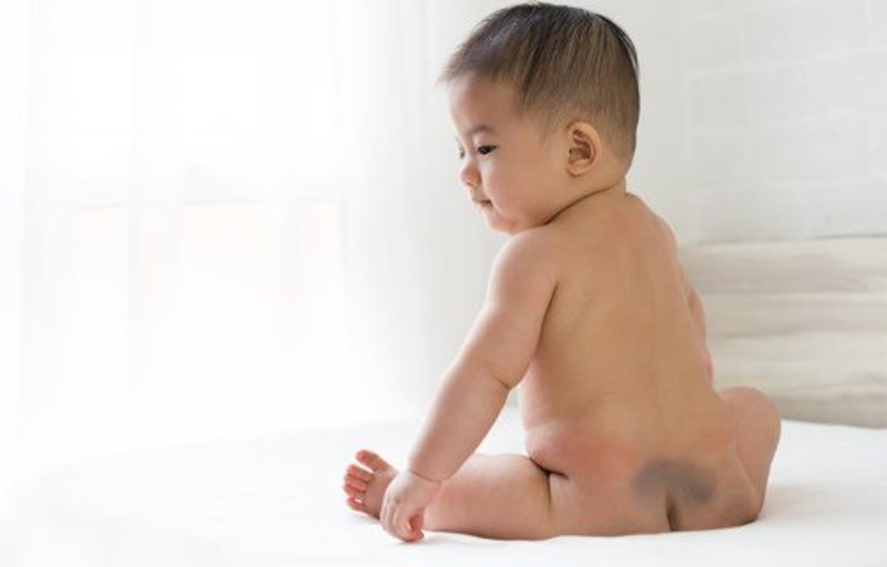 Các vết bớt ở trẻ sơ sinh thường gặp nhất và cách xử lý 1