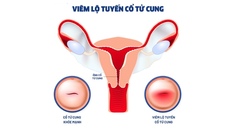 các bệnh phụ khoa thường gặp ở phụ nữ 5