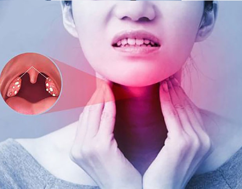 5 bài thuốc Đông Y trị viêm họng mãn tính trong dân gian 1